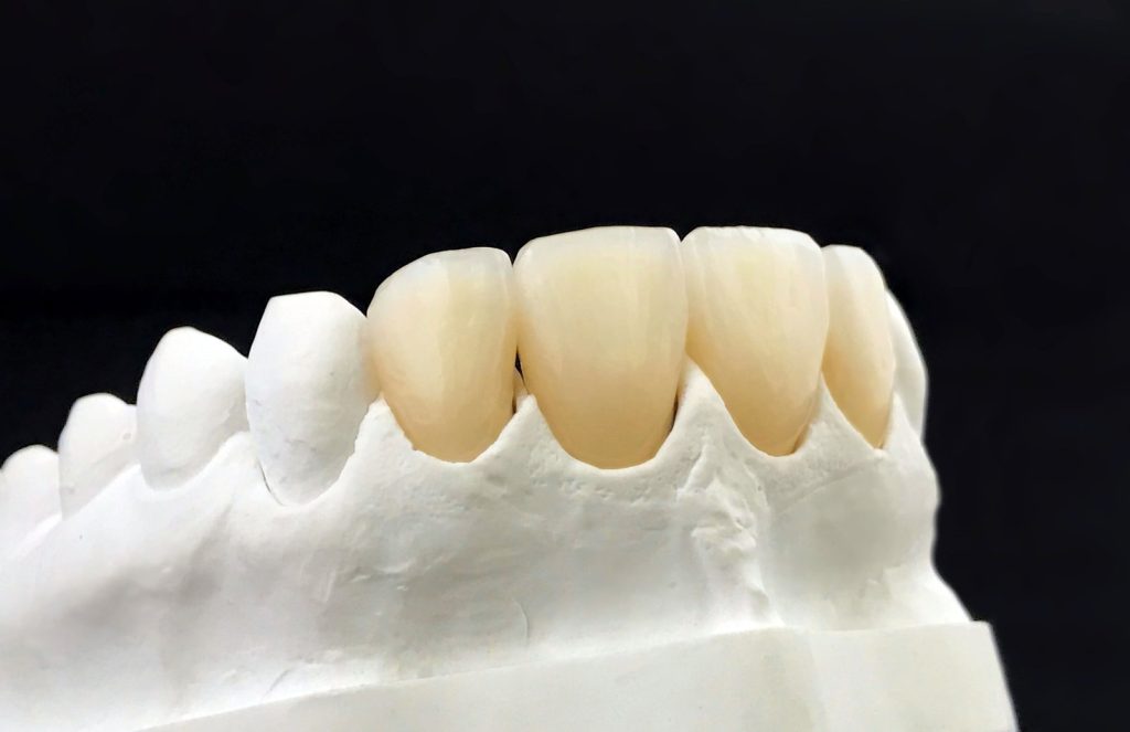 dental zirconia crowns in the plaster model white dental veneer