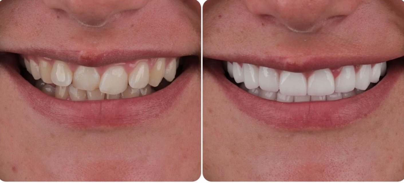 Does Teeth Whitening Damage Enamel