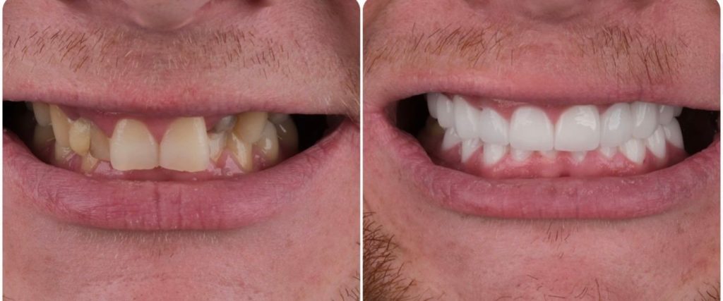 Does Teeth Whitening Damage Enamel