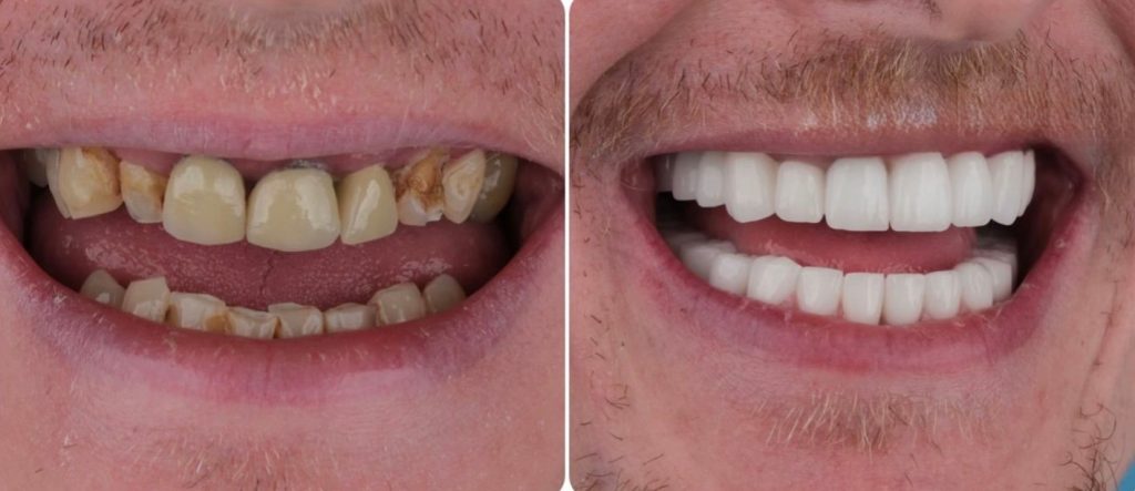 Does Teeth Whitening Damage Enamel