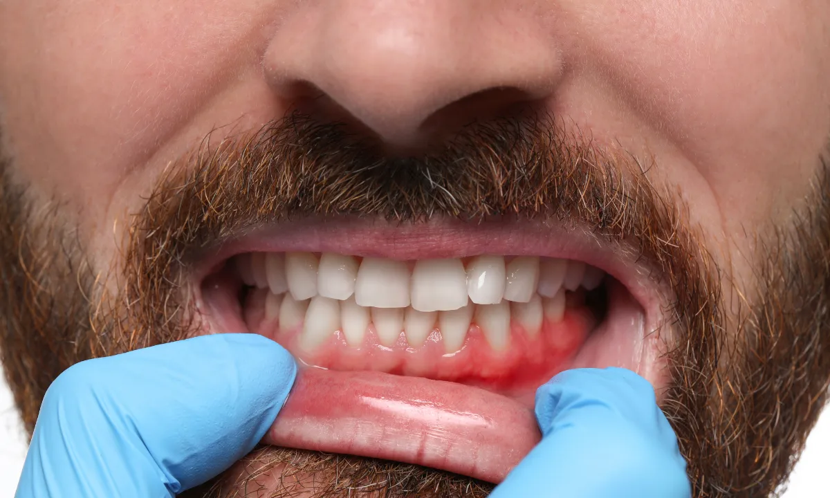 Early Signs of Gum Disease