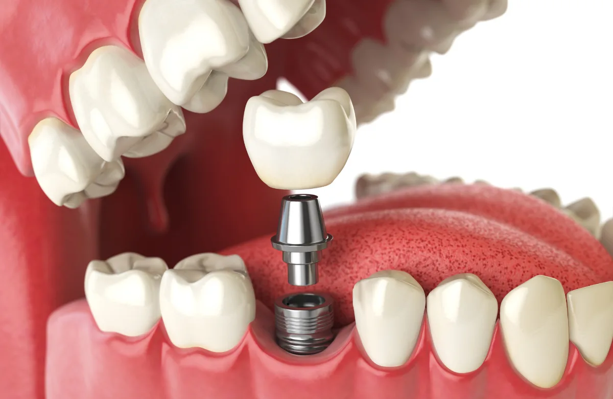 How Dental Implants Work