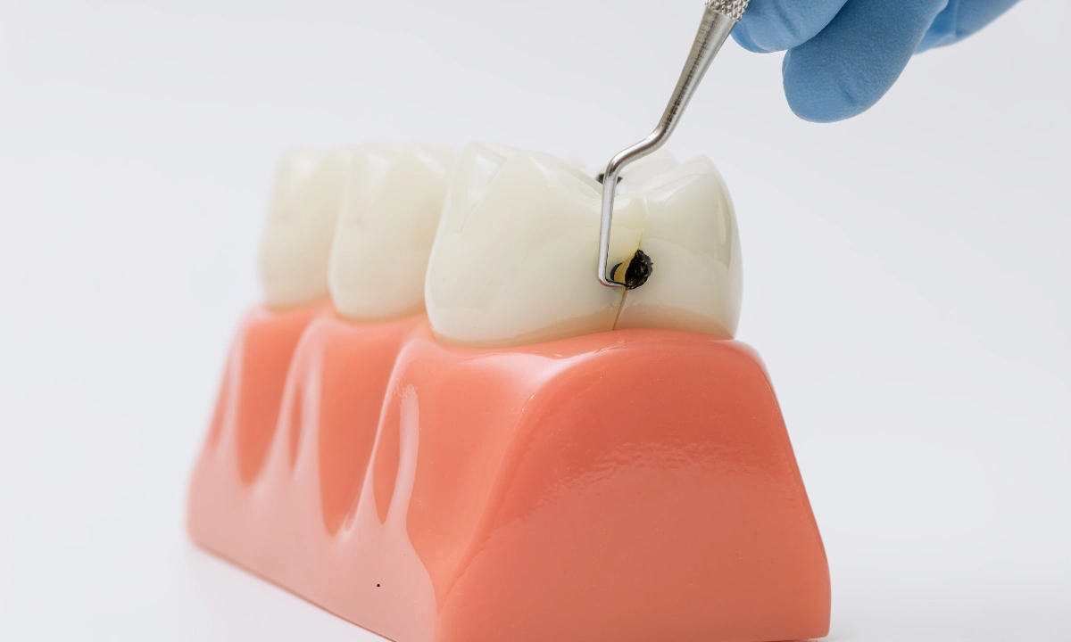 How to Prevent Cavities