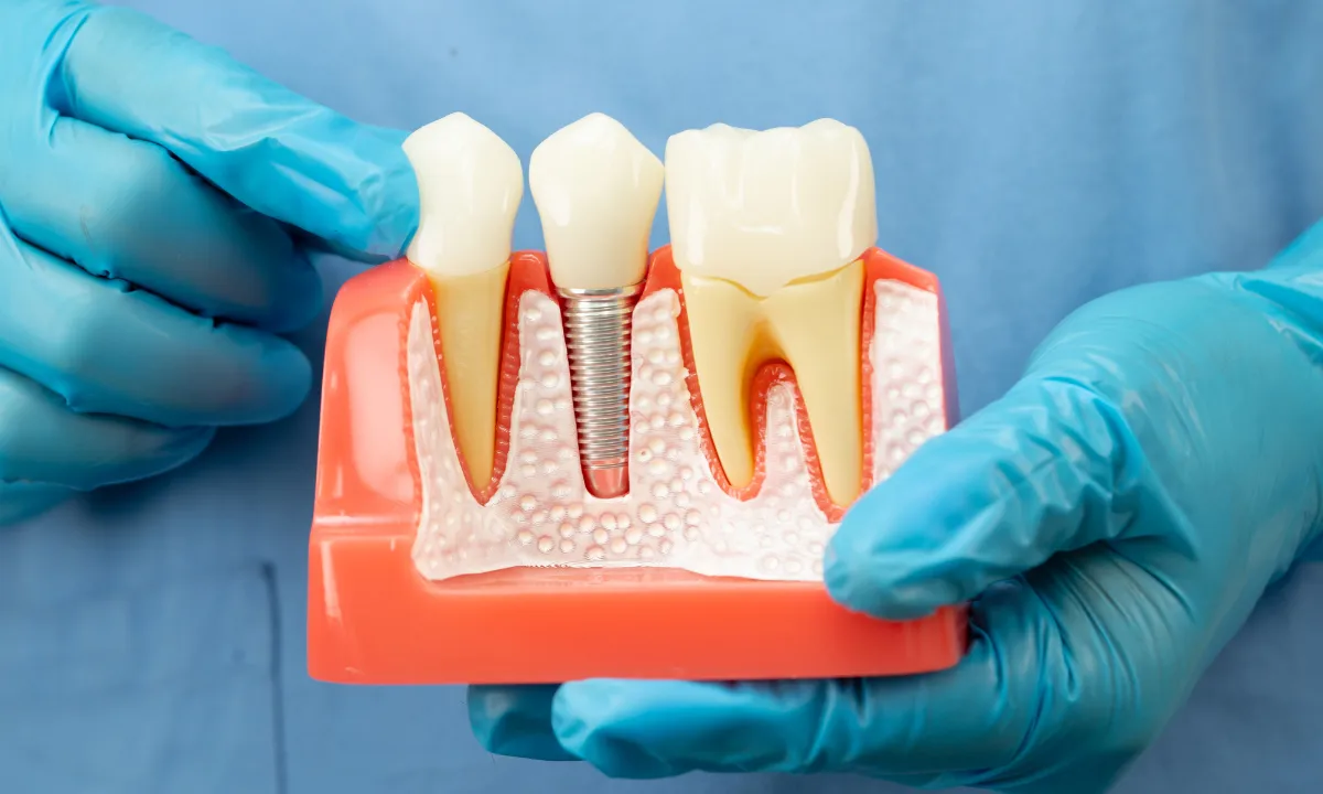 benefits of dental implants