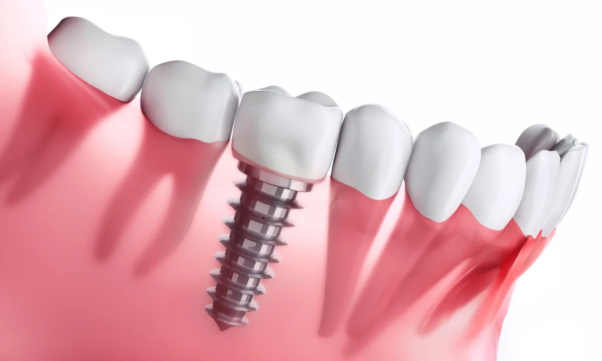 dental implant failure