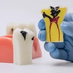 dental implant infection