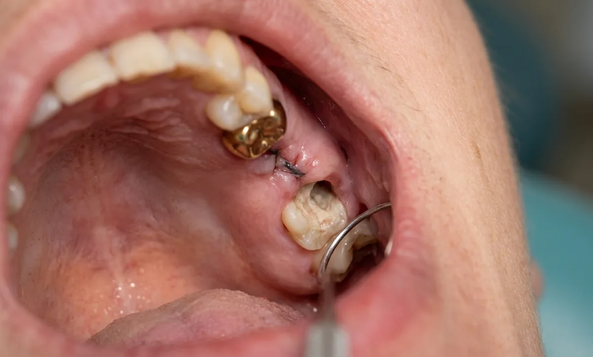 dry socket symptoms