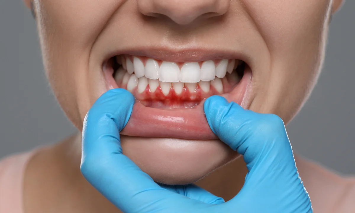 stages of gum disease